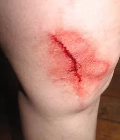 How to Prevent Cuts and Scratches How to Prevent Cuts and Scratches