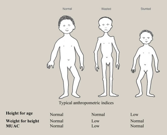 Disorders Due To Malnutrition Disorders Due To Malnutrition