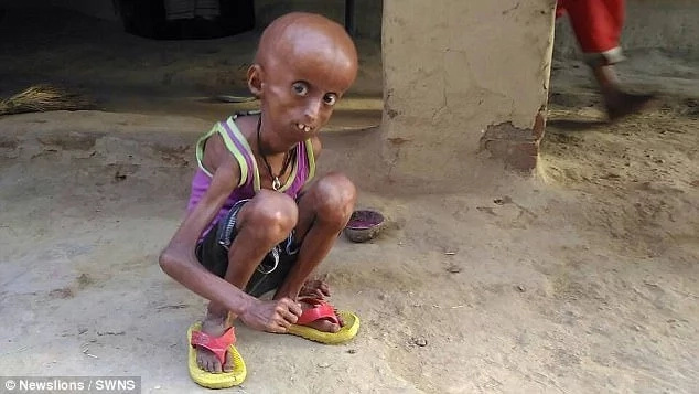 Man, 21, with rare genetic condition has body of 160-year-old pensioner Man, 21, with rare genetic condition has body of 160-year-old pensioner