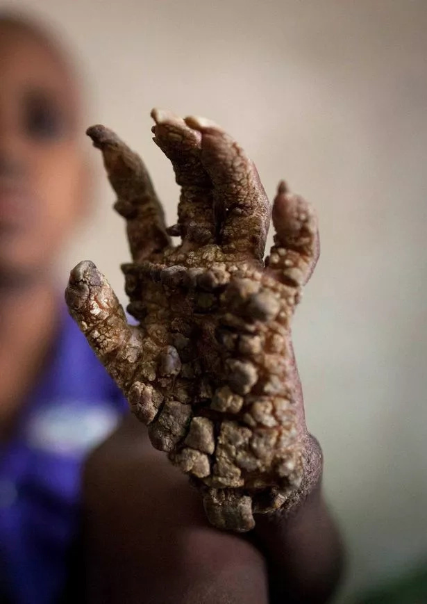 Young boy turns into a living tree due to rare disease (PHOTOS) Young boy turns into a living tree due to rare disease (PHOTOS)