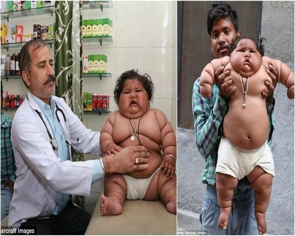 Eight months old baby from India weighs similar to that of a four years old kid, causes her to struggle breathing and sleeping! Eight months old baby from India weighs similar to that of a four years old kid, causes her to struggle breathing and sleeping!