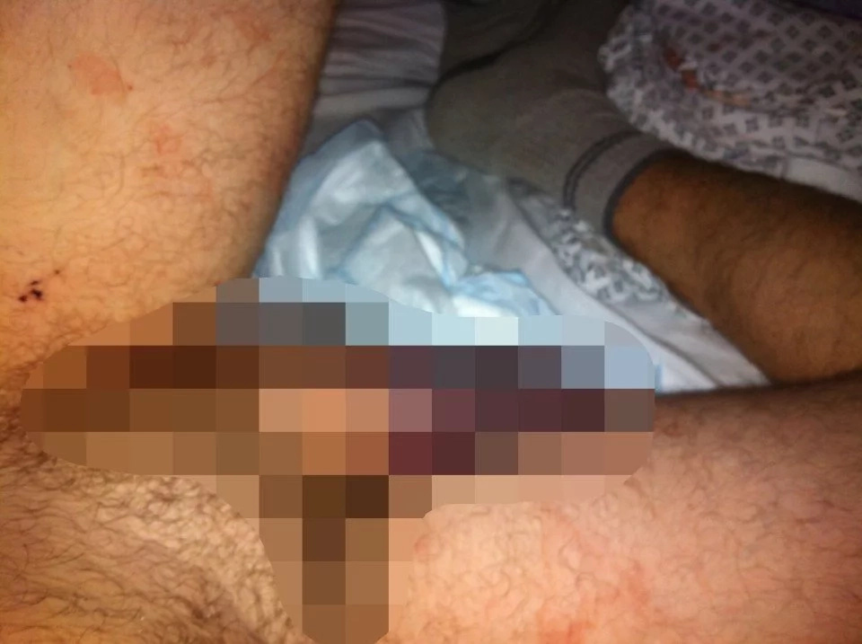 Bricklayer suffered injury after ‘rigorous doggy style’ caused his penis to snap in half (Photo) Bricklayer suffered injury after ‘rigorous doggy style’ caused his penis to snap in half (Photo)