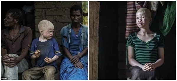 Sad! Witchdoctors hire hitmen to KILL albinos for their internal organs (photos, videos)