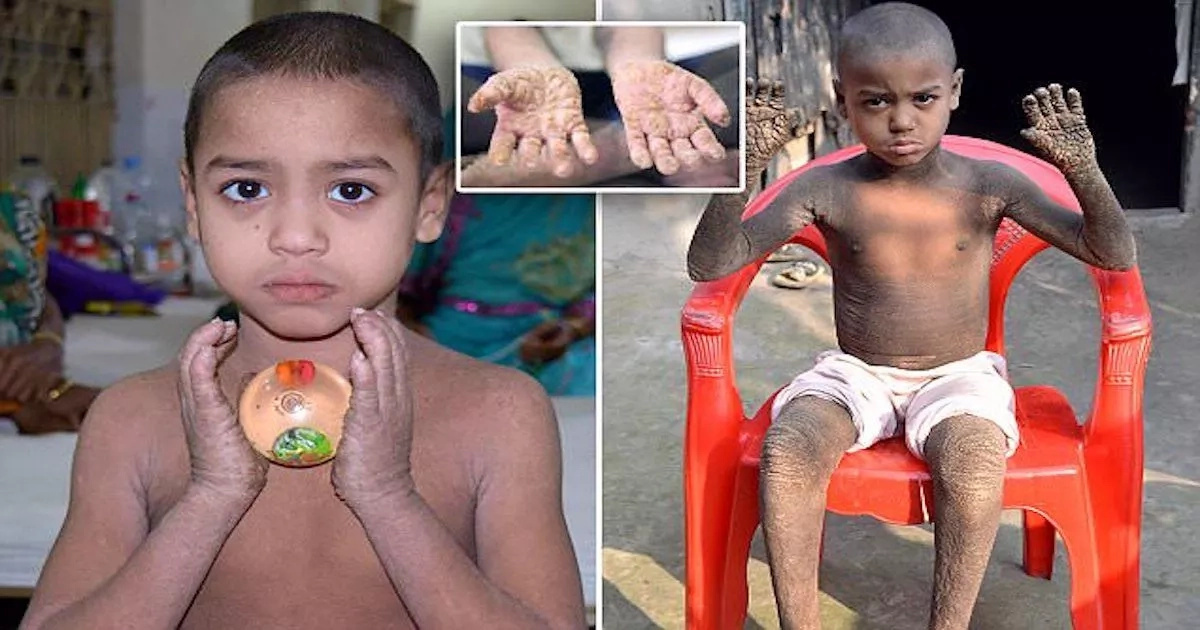 Unbelievable! Boy, 8, whose body was turning into stone, makes miraculous recovery (photos, video)