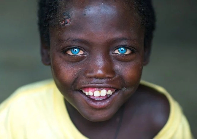 African boy, 8, has rare condition that makes his eyes a mesmerizing BLUE (photos)