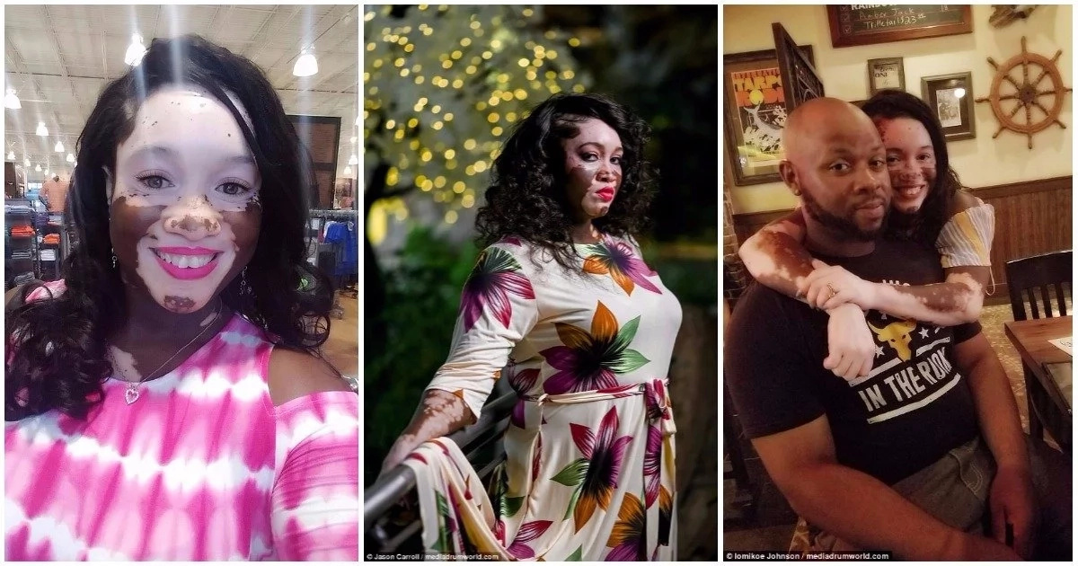 Woman with vitiligo becomes a model to empower others with the condition (photos)