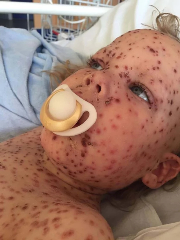 This is the worst chickenpox you ever seen This is the worst chickenpox you ever seen