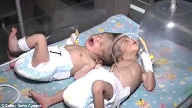 Woman, 35, gives birth to CONJOINED twins fused at head,doctors say they may be sharing brain (photos, video) Woman, 35, gives birth to CONJOINED twins fused at head,doctors say they may be sharing brain (photos, video)