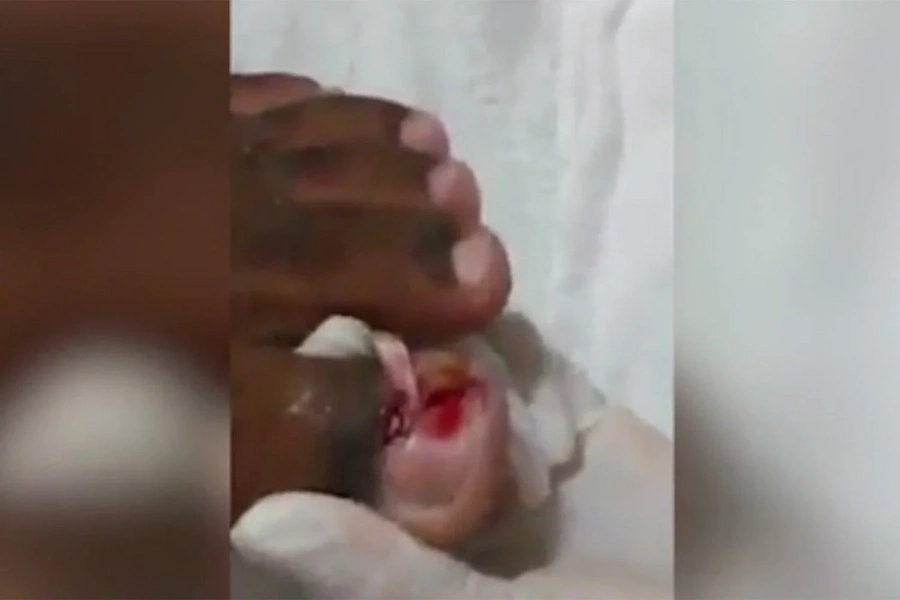 Horrific video shows what happens if you ignore an ingrown toenail Horrific video shows what happens if you ignore an ingrown toenail