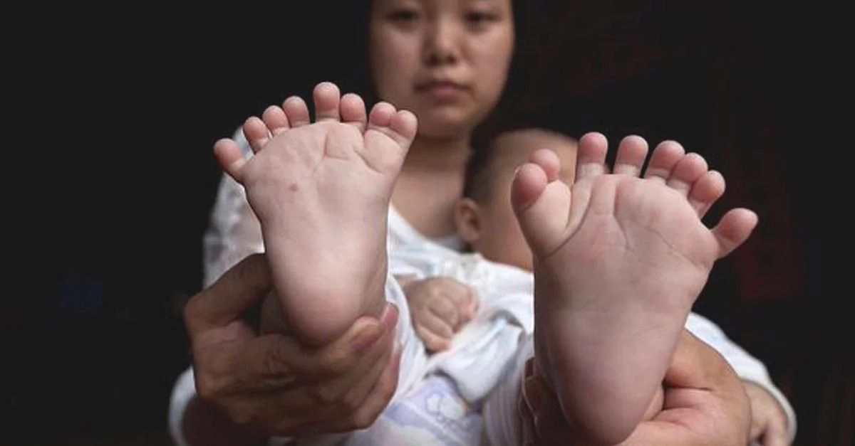 Look at the excess toes and fingers this baby has! Look at the excess toes and fingers this baby has!