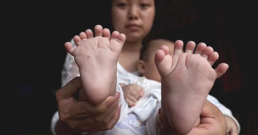 Look at the excess toes and fingers this baby has! Look at the excess toes and fingers this baby has!