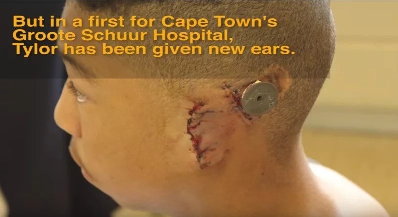 Teen gets gift of hearing after living without ears for 15 years (photos, video)