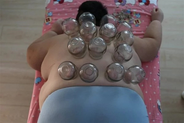 Cupping Therapy To Loss Weight