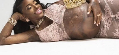 Incredible! Woman with third degree burns gives birth to a baby boy (photos)