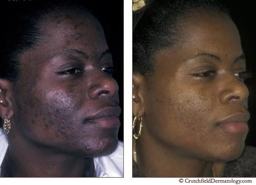 Kenyan woman teaches women how to treat acne using vaginal discharge