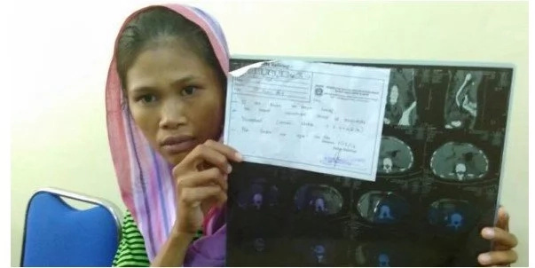 Indonesian woman gets SHOCKING NEWS that she had a kidney removed without her knowledge (photos, video) Indonesian woman gets SHOCKING NEWS that she had a kidney removed without her knowledge (photos, video)