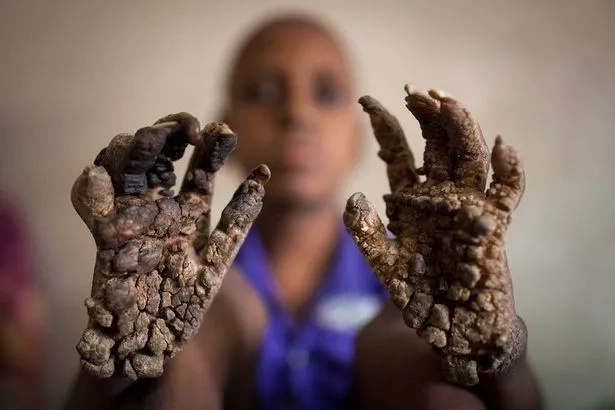 Young boy turns into a living tree due to rare disease (PHOTOS) Young boy turns into a living tree due to rare disease (PHOTOS)