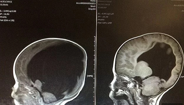 Boy born without BRAIN stuns doctors with miraculous recovery (photos)