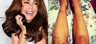 Aray! Bruised Jodi shares 'happy' first day of shoot experience for a new movie