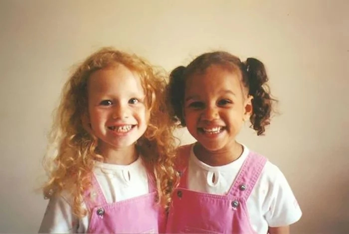 Identical Twins Born With Differenr Skin Colour Identical Twins Born With Differenr Skin Colour