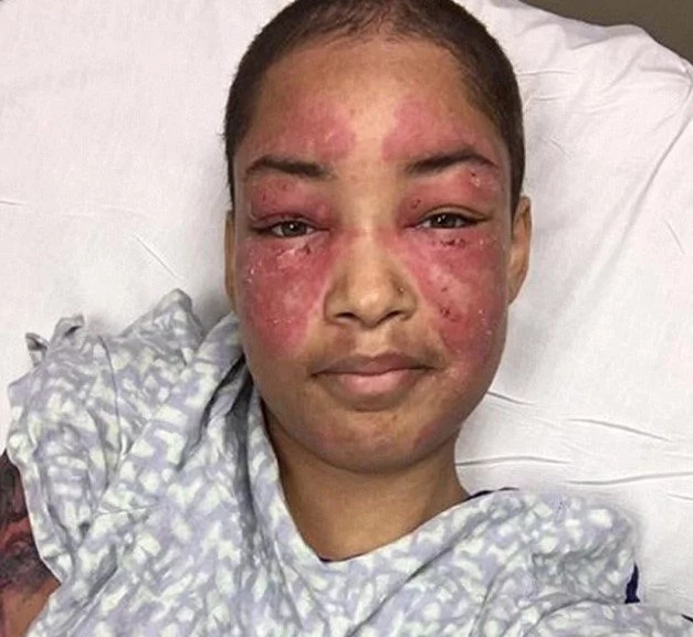 Woman’s Skin Burns From Inside Out Every Time She Goes Outside (Photos)