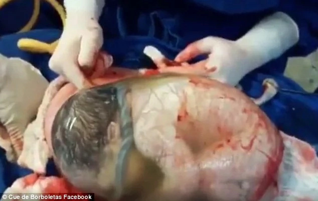 This baby was born still inside the amniotic sac (video) This baby was born still inside the amniotic sac (video)