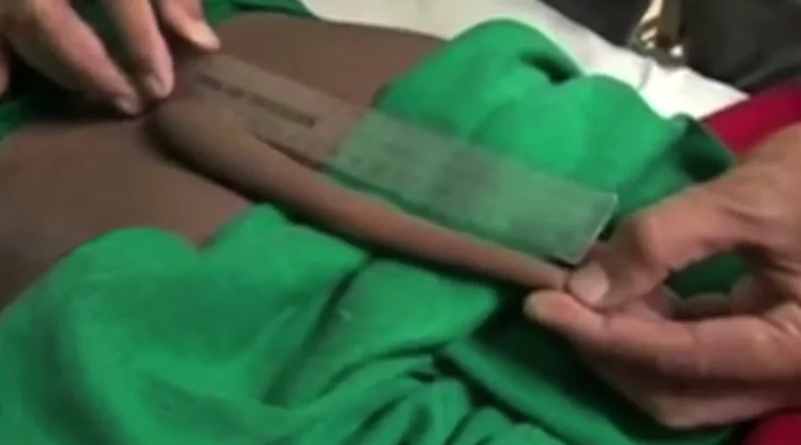 Teenager with 'longest recorded' tail gets it removed ON VIDEO Teenager with 'longest recorded' tail gets it removed ON VIDEO