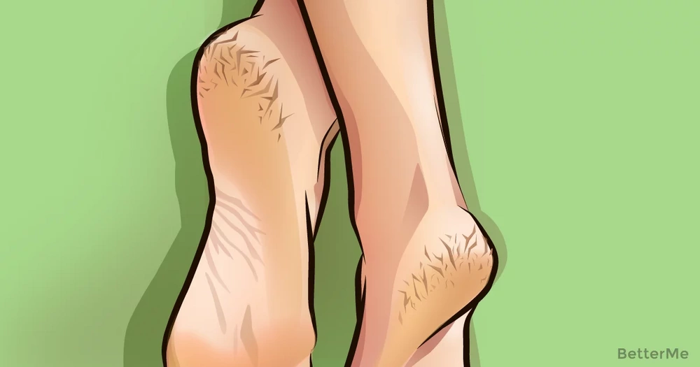 home remedies for severely dry cracked feet