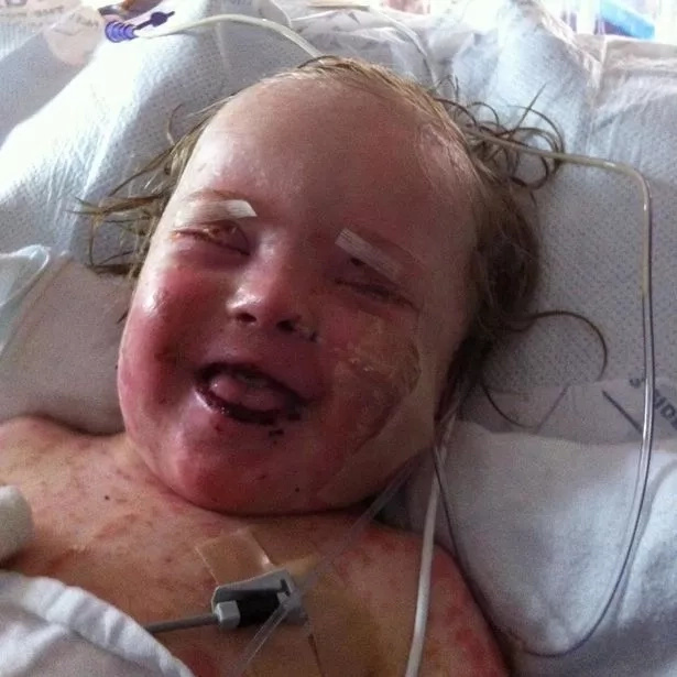 Little boy looks like he burnt in the fire after rare allergy Little boy looks like he burnt in the fire after rare allergy
