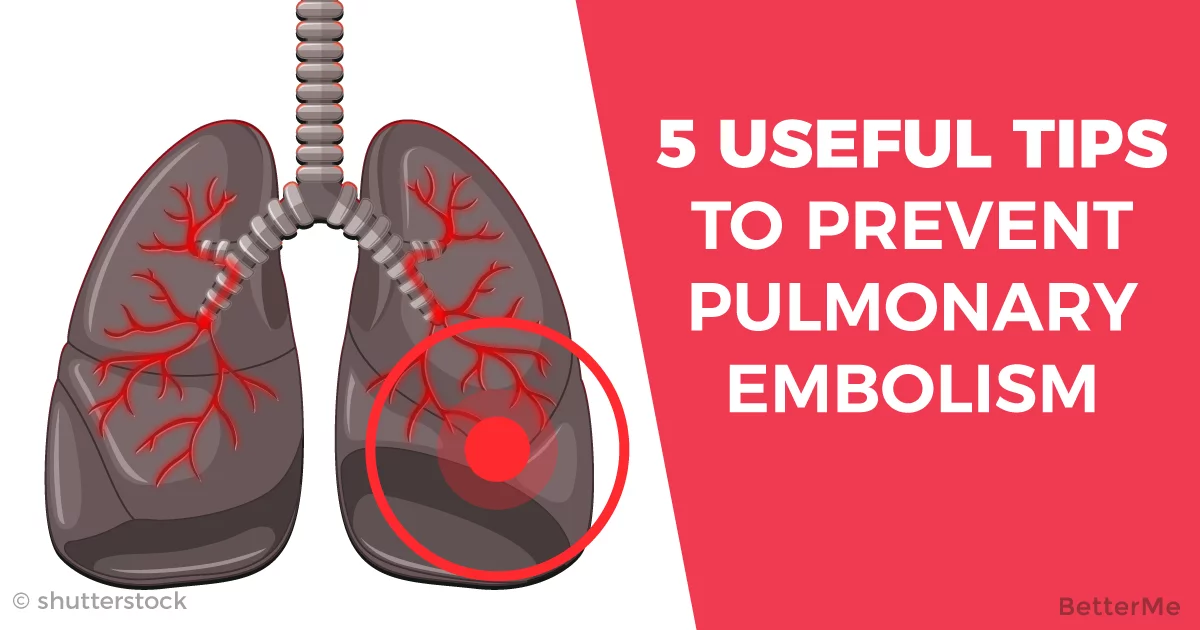 5 Useful Tips To Prevent Pulmonary Embolism