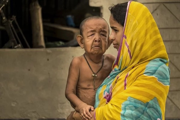 Little boy stuck in the old man’s body due to horrendous disease Little boy stuck in the old man’s body due to horrendous disease
