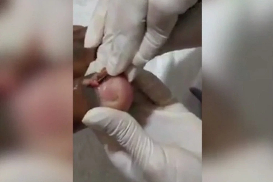 Horrific video shows what happens if you ignore an ingrown toenail Horrific video shows what happens if you ignore an ingrown toenail