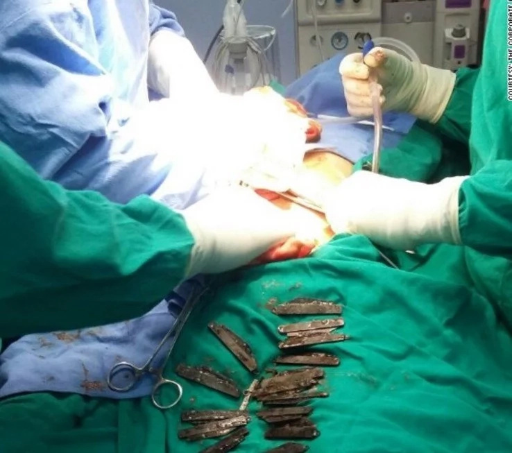 Man who swallowed 40 KNIVES rushed to hospital in agony (photos, video)