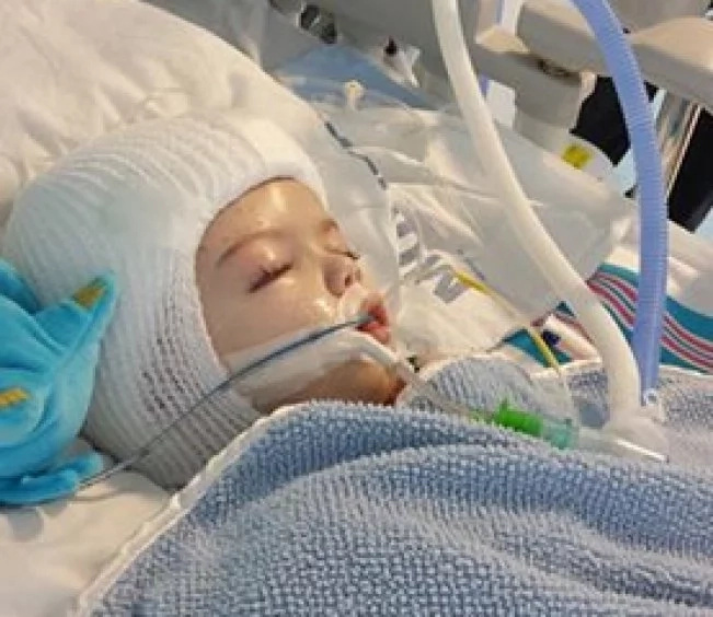 Conjoined twins, who shared one head, are successfully separated! Both toddlers survived! PHOTOS Conjoined twins, who shared one head, are successfully separated! Both toddlers survived! PHOTOS