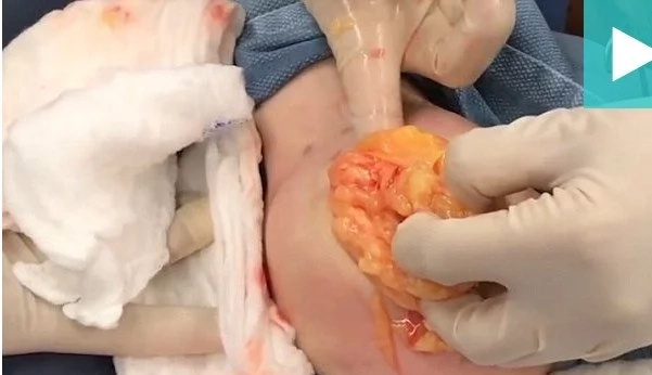 Disgusting Moment Doctor Removes HUGE Ball Of Fat From Woman's Arm Disgusting Moment Doctor Removes HUGE Ball Of Fat From Woman's Arm