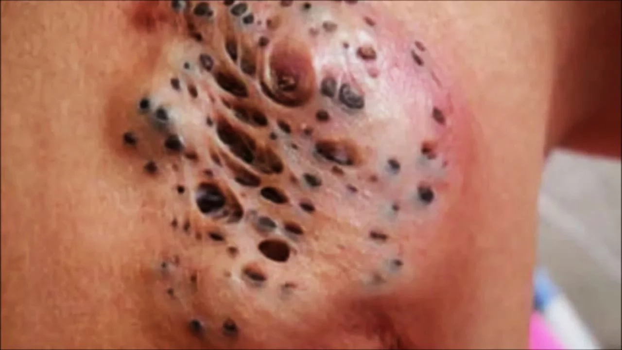 Blackhead popping causes more harm than good Blackhead popping causes more harm than good