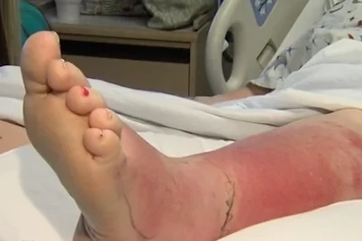 Doctor's warning after pedicure gives woman nasty infection that left her unable to walk
