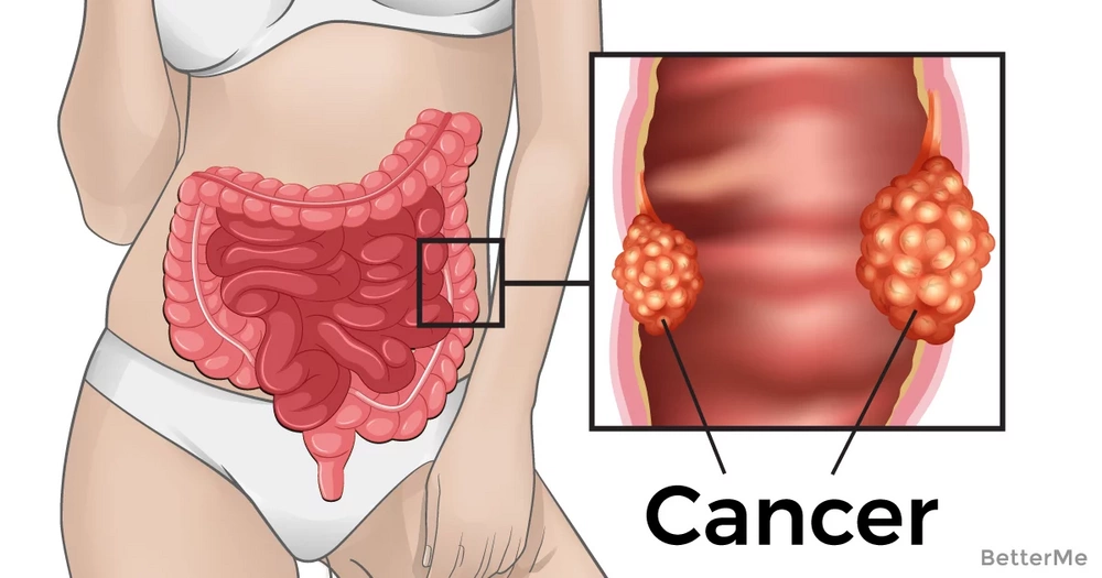 What Is The First Sign Of Rectal Cancer 15 Warning Signs Of Colon