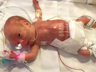 One of the Smallest Babies Ever Born in the World Shares 1st Cuddle with Her Dad