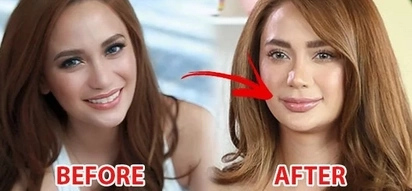 Retokada queen na rin siya? Arci Muñoz keeps mum about accusations she underwent lip-injection despite obvious disparity of before after photos