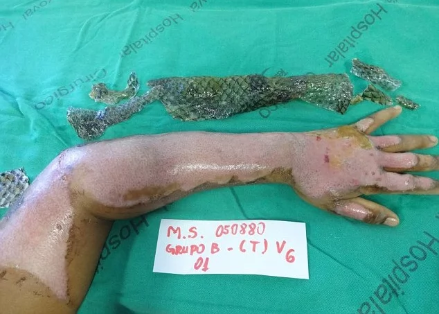 Fish Scales for Burn Treatment? Results are Definitely Unexpected! Fish Scales for Burn Treatment? Results are Definitely Unexpected!