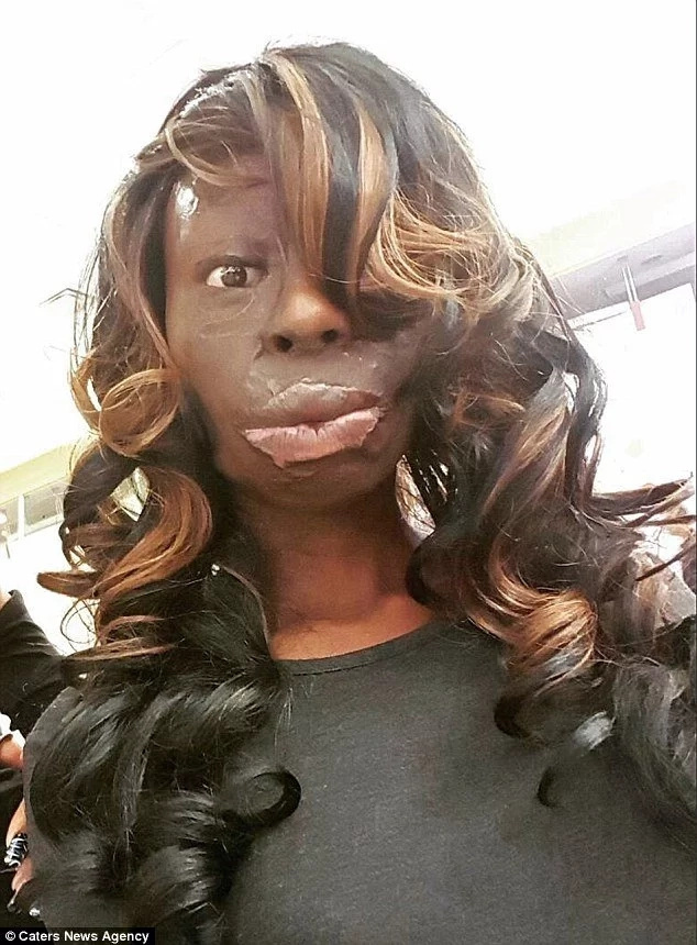 Meet burns survivor, 25, who wears her flaws like diamonds and rejects surgery (photos) Meet burns survivor, 25, who wears her flaws like diamonds and rejects surgery (photos)