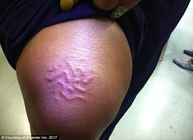 Woman 45 Discovers Worm Buried Under Her Skin 2 Weeks