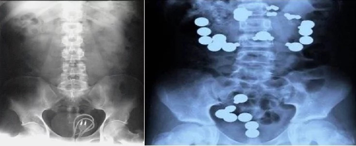 Crazy x-rays you won’t wish to see! We wonder how they ingested these items! Crazy x-rays you won’t wish to see! We wonder how they ingested these items!