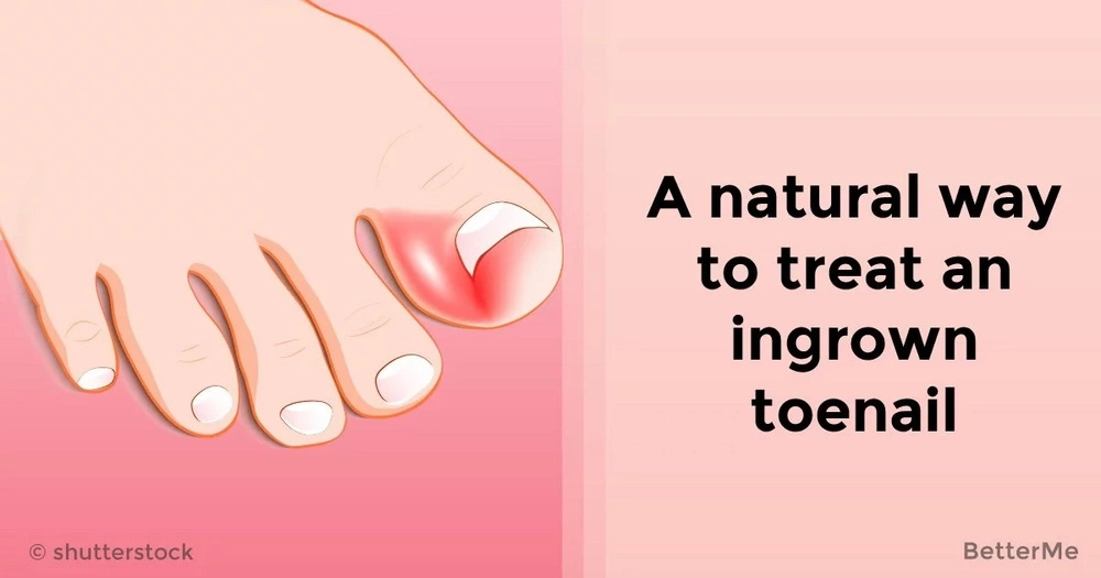 How To Cut Of Painful Toe Nail Hang Skin