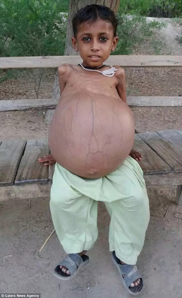 Shah has a rare condition that blocks bowel movement Shah has a rare condition that blocks bowel movement