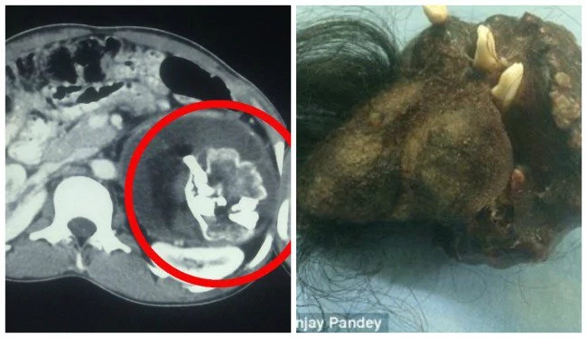 Parasitic Twin With Teeth And Hair Found In Teen's Body Parasitic Twin With Teeth And Hair Found In Teen's Body