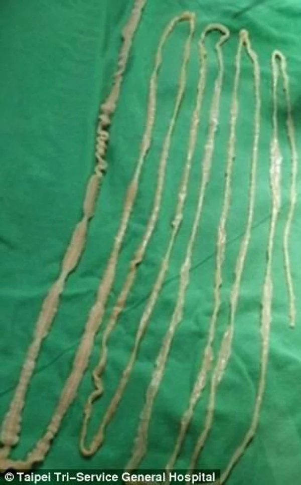 Girl finds tapeworm in tummy after eating sashimi Girl finds tapeworm in tummy after eating sashimi