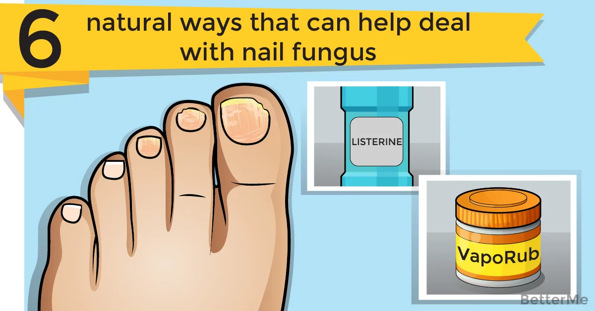 6 natural ways that can help deal with nail fungus