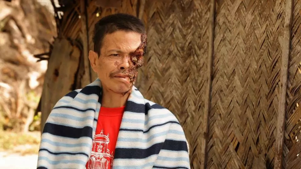 Tatay Gilbert is full of hope despite losing half of his face Tatay Gilbert is full of hope despite losing half of his face